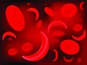 THE HISTORY OF SICKLE CELL